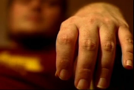 Sla, un endocannabinoide potrebbe aiutare i pazienti a mantenere la muscolatura