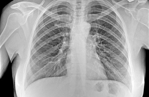 Broncopneumopatia ostruttiva (Bpco), una patologia disabilitante e il fumo, lo chiarisce il Cnr
