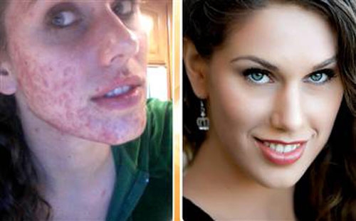Un po’ di trucco e l’acne giovanile sparisce. I consigli di Cassandra Bankson spopolano il web