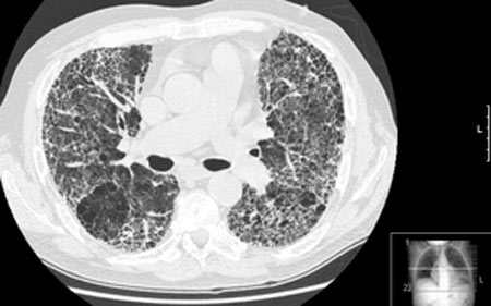 Fibrosi Polmonare Idiopatica, anche il Policlinico Gemelli offre il pirfenidone
