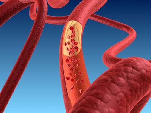 Ipercolesterolemia omozigote, confermata l’efficacia di lomitapide