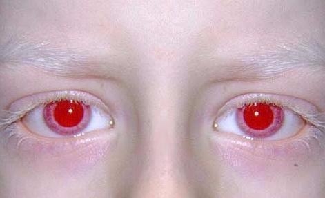 L’albinismo ieri e oggi. Professionisti, Albini e loro Familiari a Confronto