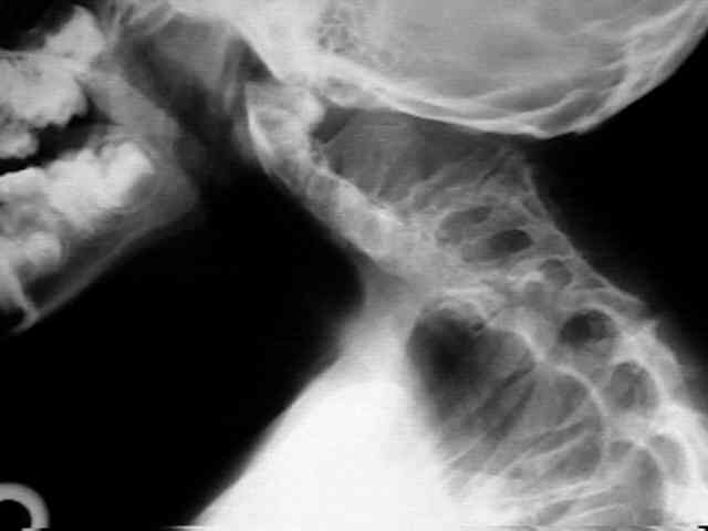 Sindrome di Klippel Trenaunay Weber. Anna è stata abbandonata dalle istituzioni