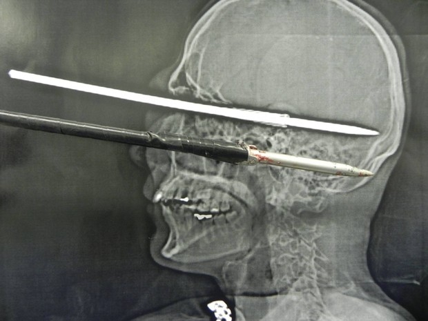 Miracolo in Brasile. Si conficca un arpione nel cranio, nessun danno cerebrale. LA FOTO CHOC