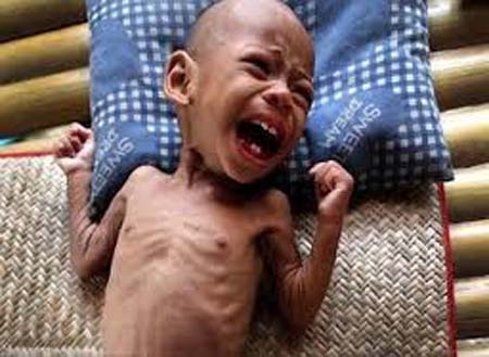 Unicef. Nel Mondo un bambino su 4 soffre di malnutrizione cronica