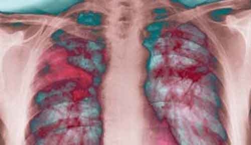 Fibrosi Polmonare Idiopatica, finita l’attesa dei pazienti. Il Pirfenidone finalmente in commercio