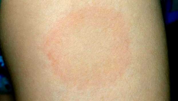Malattia di Lyme, si cercano terapie e vaccino ma intanto va prevenuta