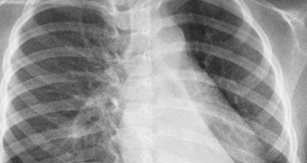 Ipoplasia alla trachea in bimbi. Primato mondiale per tecnica mini-invasiva al Meyer di Firenze