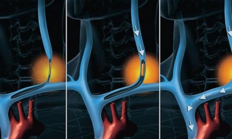 Sclerosi Multipla, una possibile speranza terapeutica dalle cellule staminali adulte riprogrammate