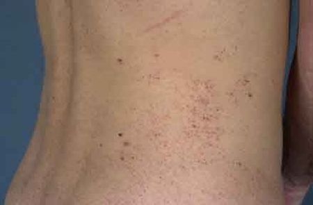 Malattia di Fabry: diagnosi precoce e giusta terapia per una vita normale