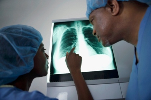 Fibrosi Polmonare Idiopatica, una Guida per aiutare i malati ad accedere al farmaco SALVA-VITA