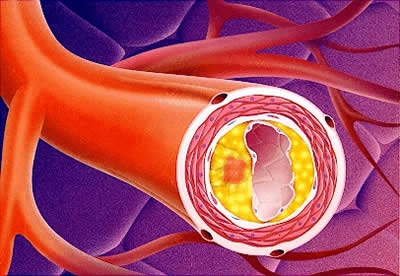 Salute. L’arteriopatia colpisce 1 paziente su 5 spore i 60 anni