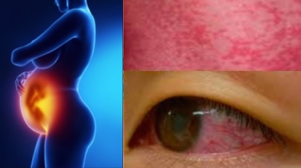 Spagna. Donna incinta affetta da Zika. Primo caso in Europa