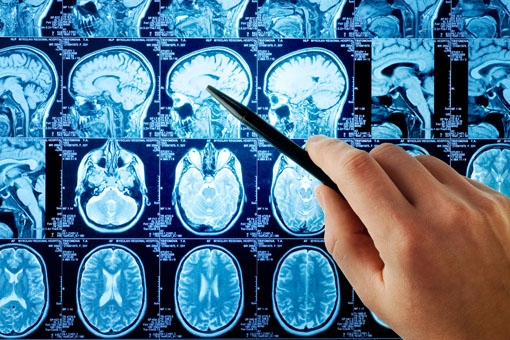 Sclerosi multipla, nei centri clinici 1 neurologo per 300 pazienti