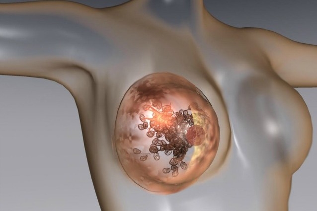 Un passo avanti contro il cancro al seno