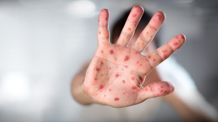 Siamo davvero diventati uno dei Paesi peggiori d’Europa per copertura vaccinale contro il morbillo?