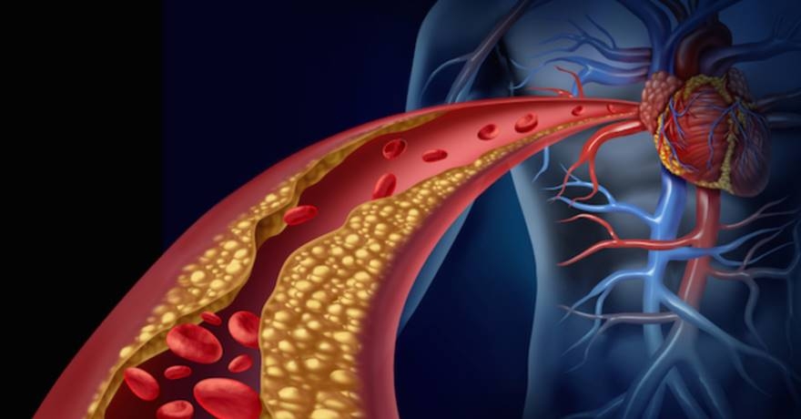 Livelli bassi di colesterolo: un rischio maggiore di aterosclerosi e patologie cardiovascolari