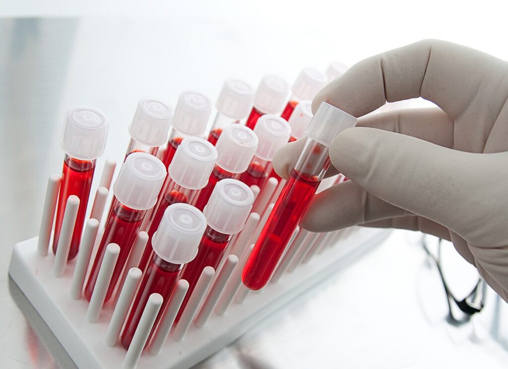 Citometria a flusso. Biopsia liquida e medicina di precisione, le nuove frontiere