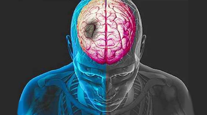 Ictus, nuove ricerche sulla riabilitazione motoria