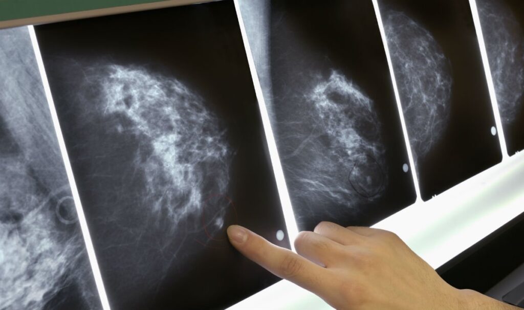 Tumore al seno. Irccs Pascale di Napoli e Roche, una terapia biologica antitumorale direttamente a casa