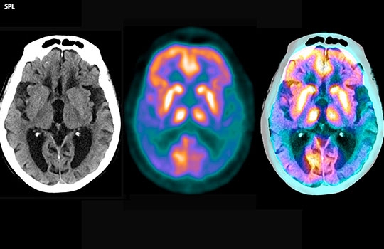 L’Alzheimer colpisce di più le donne? Una nuova ricerca spiega il perchè