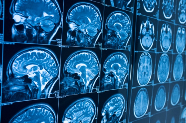 Ricerca. Nell’imaging cerebrale, il deep learning rappresenta una nuova frontiera