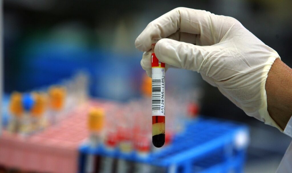 Ricerca. Cancro: predizioni personalizzate con un prelievo di sangue