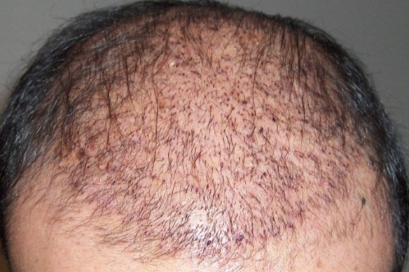Trapianto capelli: 5 curiosità che non tutti conoscono