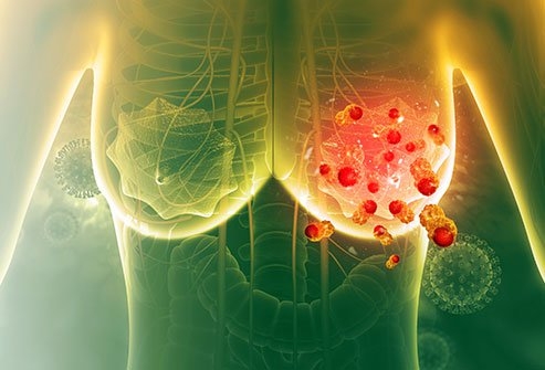Ricerca. Cancro al seno: affrontare il problema della premenopausa