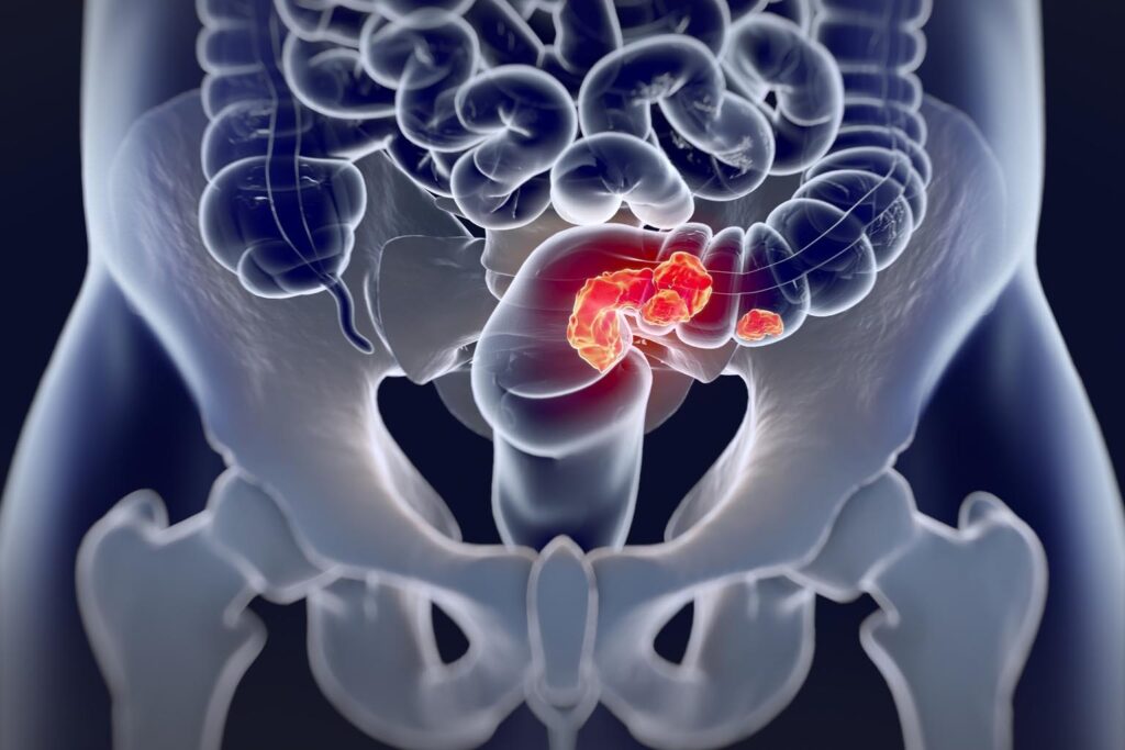 Ricerca. Tumore al colon: scoperto un meccanismo alla base della formazione delle metastasi
