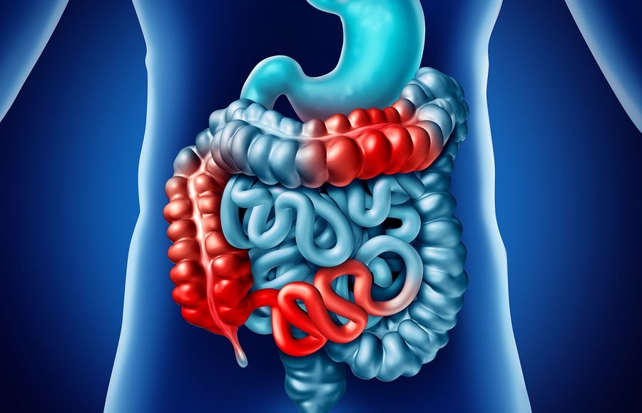 Ricerca. Dall’università di Udine nuove speranze per cura del tumore al colon retto