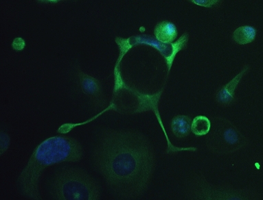 Ricerca cancro. Un webinar Italia-Giappone sulle nuove terapie emergenti
