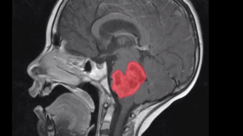 Ricerca. Due farmaci combinati contro il cancro al cervello che colpisce i bambini