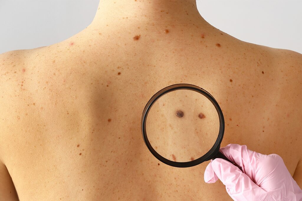 Ricerca. Tumori della pelle: nuove scoperte sui processi molecolari
