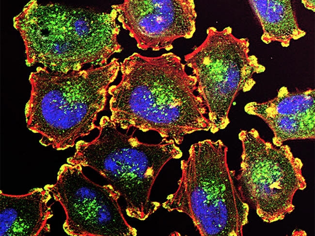 Ricerca, Prevenire le metastasi del cancro con il collagene