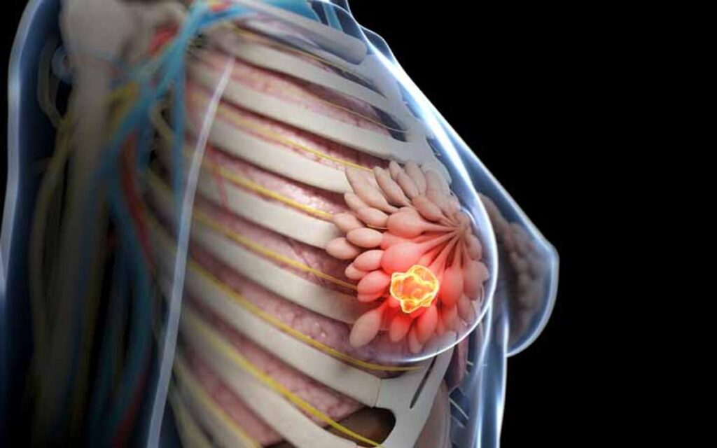 Cancro al seno. Un test rivela chi può saltare la chemio dopo l’intervento chirurgico