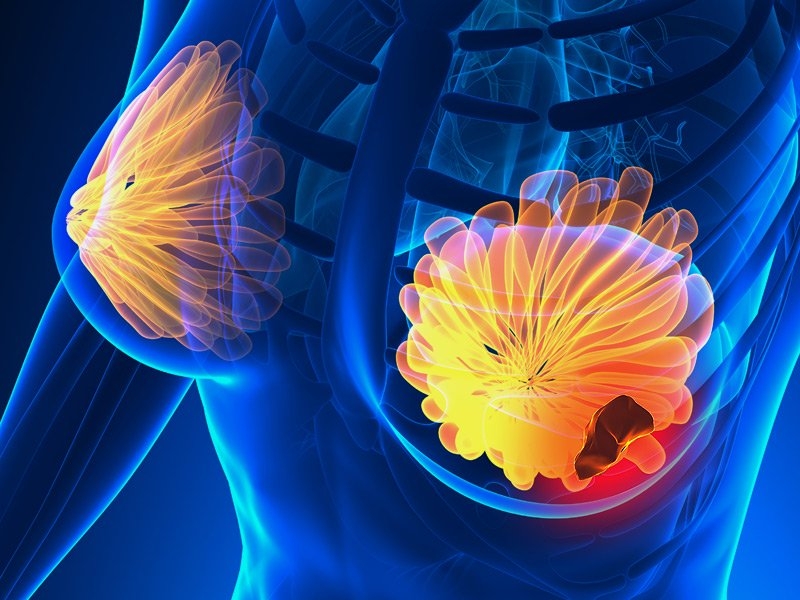 Ricerca. Scoperto un nuovo meccanismo molecolare di metastasi del tumore del seno