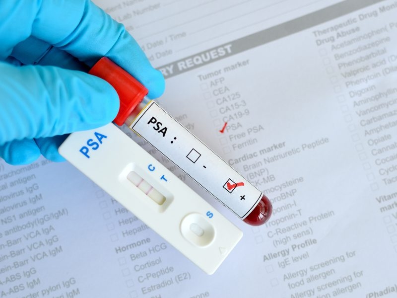 Ricerca. Scoperto un nuovo gene che conferisce resistenza al trattamento del cancro alla prostata