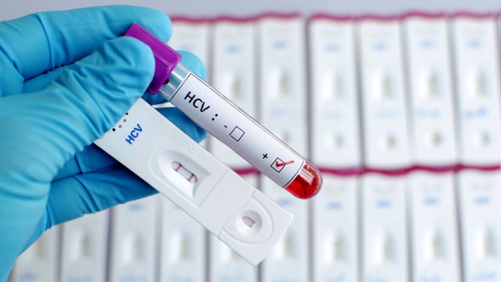 Da Roche un nuovo test diagnostico contro il virus dell’epatite C