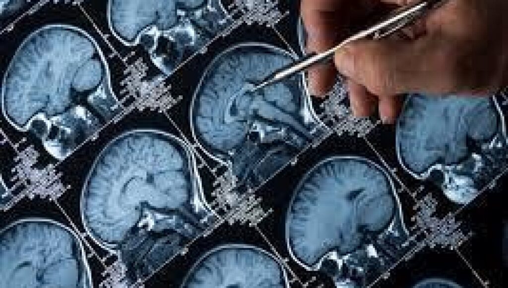 Ricerca. Una dieta ultra elaborata aumenta il rischio di demenza