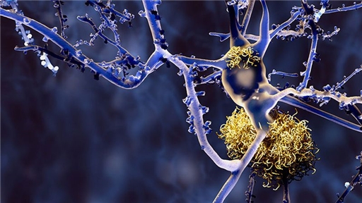 Alzheimer, Roche impegnata da sempre sulla ricerca
