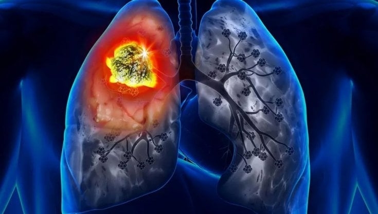 Ricerca. Scoperto come l’inquinamento atmosferico provoca il cancro ai polmoni