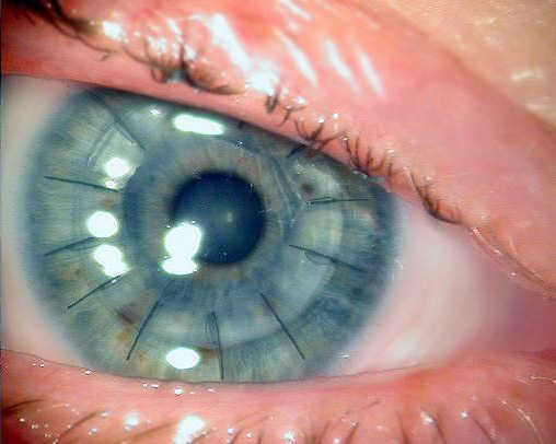 Medicina. L’Italia un’eccellenza per i trapianti della cornea