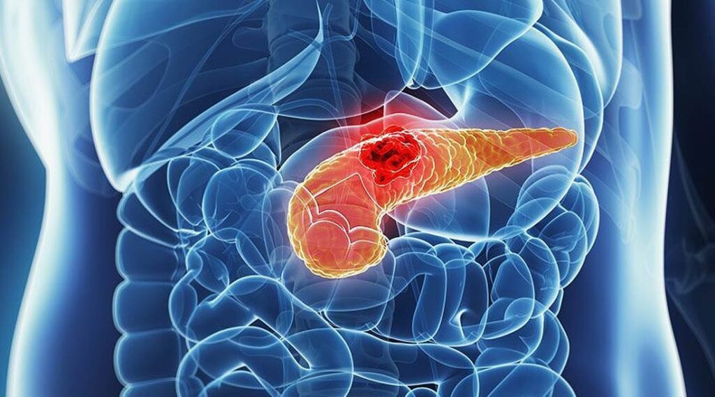Ricerca. Fondazione Humanitas, a caccia dei “big killer” cancro il pancreas