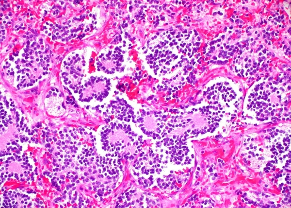 Ricerca. Università Federico II: identificati i fattori genetici che predispongono al neuroblastoma
