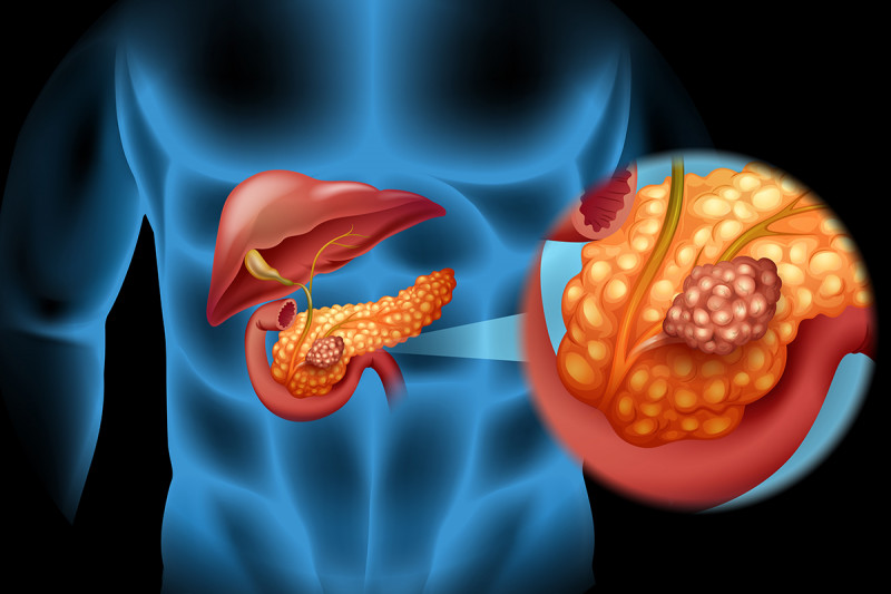 Ricerca sull’origine cellulare dei fibroblasti associati al tumore al pancreas