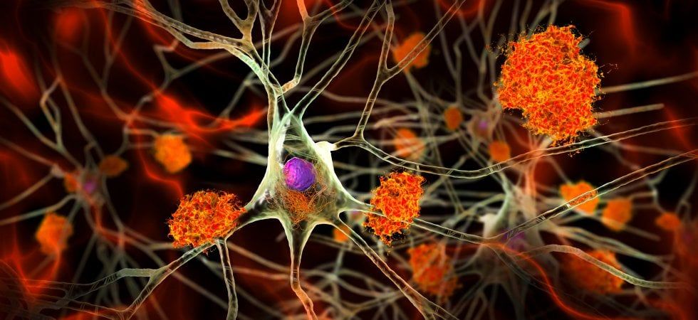 Ricerca. Nuove nanoparticelle modificano gene Alzheimer nei topi