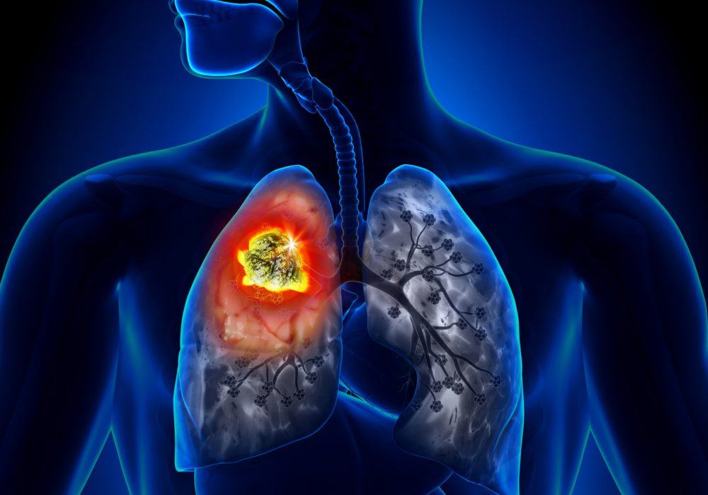 Ricerca. Dal Policlinico Gemelli un avatar per trattare il cancro al polmone