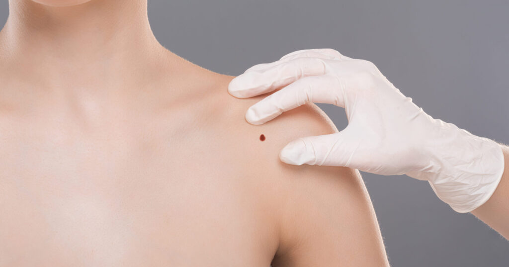 Tumore alla pelle. Al Gemelli di Roma arriva la biopsia virtuale