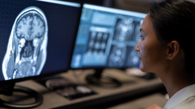 Ricerca. Alzheimer: alterazioni molecolari negli astrociti condizionano il cervello